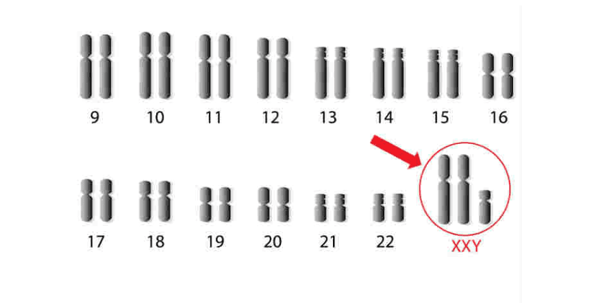 Sindrome di Klinefelter: il Presidente dell'associazione Unitask